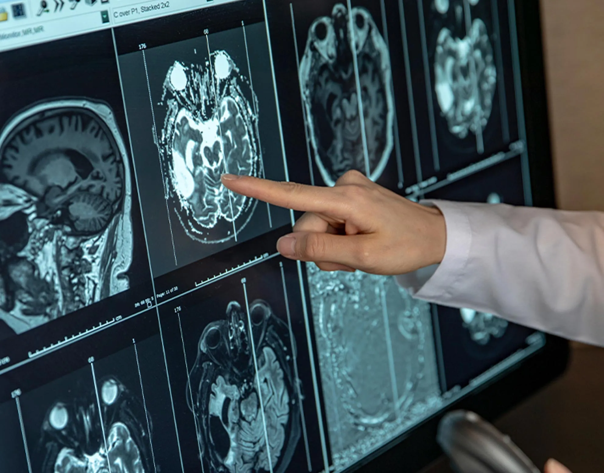 reports and comparative of cancer patients for hospice care