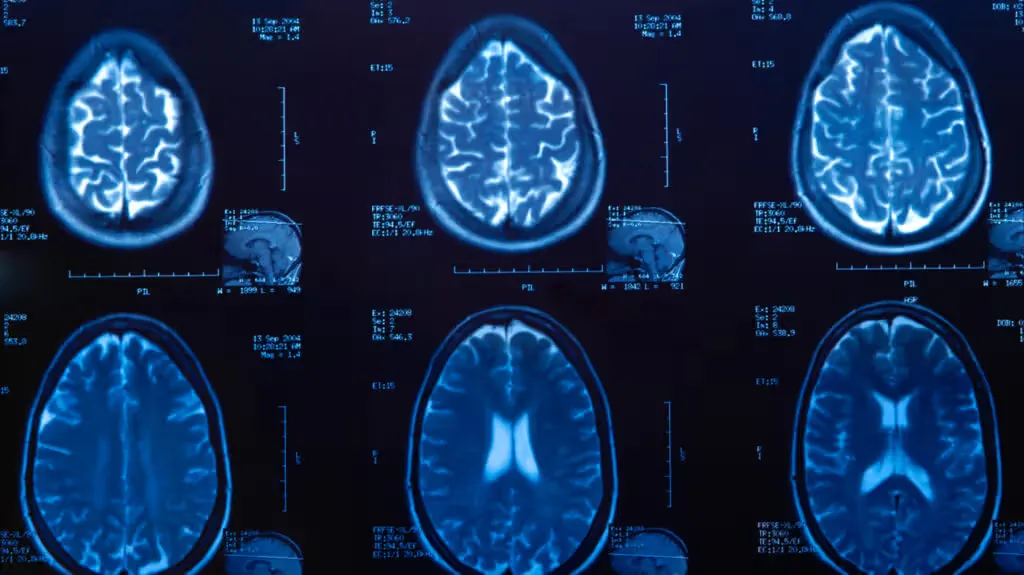 comparative data for patients wth parkinson's disease and considering hospice care options in mesa arizona